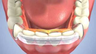 Hawley Spring Aligner Naidu Orthodontics [upl. by Octavus]