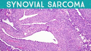 Synovial Sarcoma explained in 5 minutes Soft Tissue Pathology Basics [upl. by Aryc750]