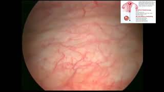 CystoscopyBladder Uterus Exam Cystoscopy Hysteroscopy ProcedureUrology Gynecology Treatment [upl. by Anohr]