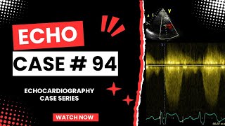 ECHO CASE 94  Echocardiography for Beginners  Echocardiogram Interpretation  2D Echo Basics [upl. by Neira553]