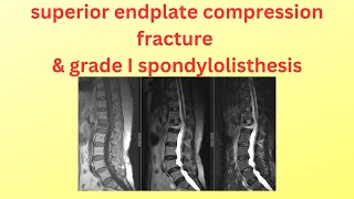 superior end plate compression fracture [upl. by Haven]