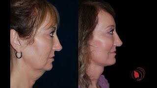 Segmental Endoscopic Brow Lift Lower Lid SOOF lift blepharoplasty Deep Plane Facelift [upl. by Atikihs]