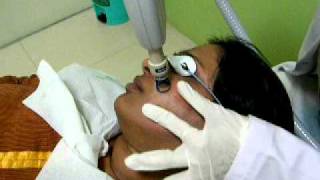 Fractional Erbium YAG Laser Treatment for Acne Scars  Dr Rinky Kapoor [upl. by Levi244]