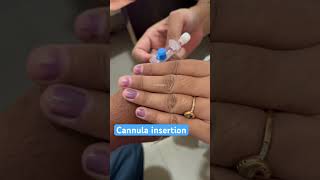 Cannula insertion of male patient on Thumb nurses cannula doctor neet mbbs bscnursing shorts [upl. by Sidnac]