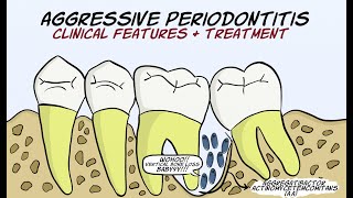 Aggressive Periodontitis Part 2  Clinical features and treatment [upl. by Atnwahsal]