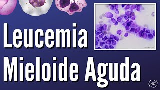 Leucemia Mieloide Aguda [upl. by O'Reilly137]