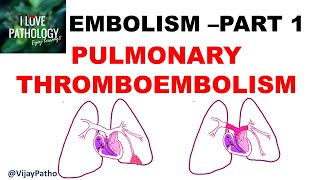 EMBOLISM Part 1 Pulmonary amp Systemic thromboembolism [upl. by Eitsirc]