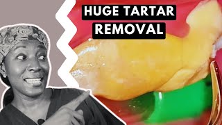 Massive TARTAR REMOVAL from teeth  TEETH CLEANING [upl. by Ahsinaw]