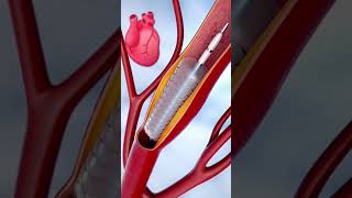 Coronary Angioplasty and stent insertion animation shorts  anatomy  heart 3d animation [upl. by Eednas]