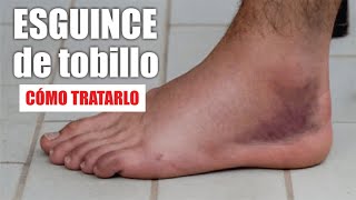 ESGUINCE o TORCEDURA de TOBILLO 🦶🏼 Tratamiento De Rotura De LIGAMENTOS De Tobillo ⭐ Dr EDSON SERRANO [upl. by Ybok419]