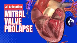 Mitral Valve Prolapse  3D Animation [upl. by Sidoeht]