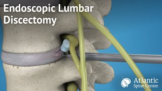 Endoscopic Lumbar Discectomy [upl. by Meisel]