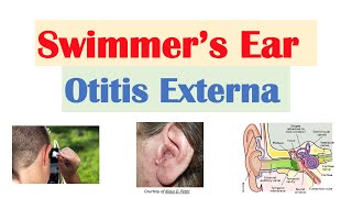 Swimmer’s Ear Otitis Externa  Risk Factors Causes Signs amp Symptoms Diagnosis Treatment [upl. by Lanford]