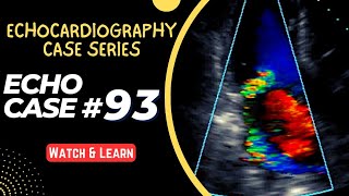 ECHO CASE 93  Echocardiography for Beginners  Echocardiogram Interpretation  2D Echo Basics [upl. by Ahsieat595]