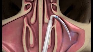 Balloon Sinuplasty Procedure with ENT Dr Timothy Ragsdale [upl. by Regina]