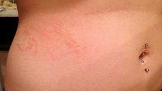 ❄Scabies Rash Images How To Remove Scabies From Hair Scabies After Treatment Scabies Life Cycle [upl. by Sulohcin297]