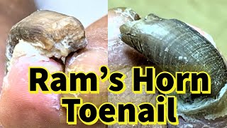 Rams Horn Toenail Severe Fungal Toenail [upl. by Marketa272]