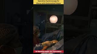 Operative Hysteroscopy for Uterus with Endometrial Polyps by Dr Rakshita Malik doctor mbbs ivf [upl. by Enilrek]