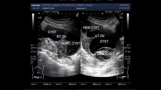 Bilateral Multiple Ovarian Cysts and Ovarian Mass [upl. by Ennairod]