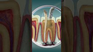 Root Canal Treatment  Curveia Dental I RCT [upl. by Sabine]