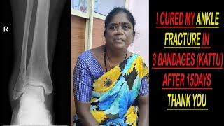 ANKLE FRACTURE TREATMENT REVIEW  BANGALORE PUTTUR KATTU  ANEKAL PUTTUR KATTU anekalputturkattu [upl. by Marela128]