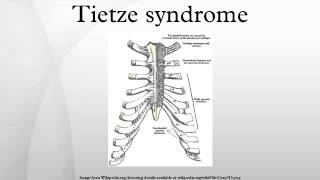 Tietze syndrome [upl. by Conyers849]