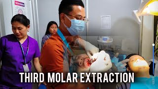 Third Molar Extraction [upl. by Wadell]