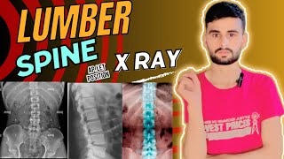 Lumber spine  lumber spine x ray  lumber spine c ray positioning  x ray [upl. by Innaig663]