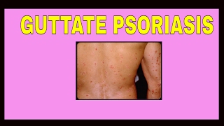 Guttate Psoriasis  Symptoms  Treatments  Causes  Pictures  Type [upl. by Yelik626]