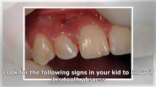 Abscessed Tooth In Child  Causes Symptoms And Treatment [upl. by Ednalrym244]