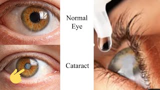 The 1 Remedy for Cataracts [upl. by Roeser]