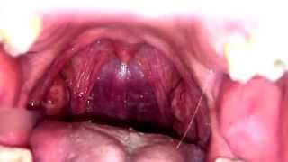 Slow Mo Tonsil Stone Removal [upl. by Eniron]