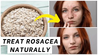 DIY Rosacea Treatments Natural Remedies That Actually Work  Skincare Tips [upl. by Cordula]