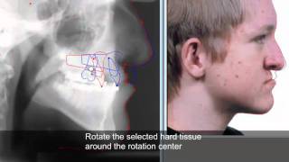 Treatment planning and soft tissue prediction 9 with Facad software [upl. by Patterson]