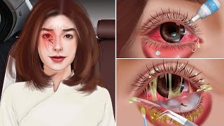 ASMR Causes and The best treatment eyes swollen eyesbeautiful eyes [upl. by Anevad799]