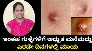 ಕುರುವಿಗೆ ಅಧ್ಬುತ ಮನೆಮದ್ದು  Home remedies for Heat Boils in Kannada How to get rid of heat pimples [upl. by Natlus42]