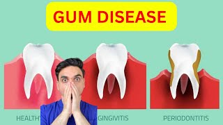 Gingivitis Vs Periodontitis Watch This Before It is TOO LATE [upl. by Rasure]