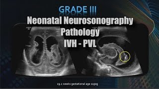 Neonatal Neurosonography  Pathology  IVH  PVL [upl. by Carrillo]