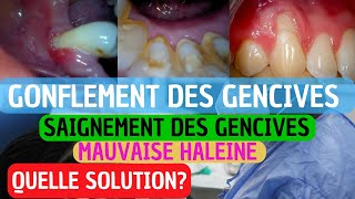 Pourquoi Vos Gencives Saignent  Causes Prévention et Traitement de la Gingivite [upl. by Notlih]