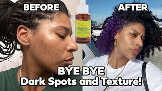 Watch My 3 Week Transformation with Good Molecules Discoloration Correcting Serum [upl. by Fraya43]