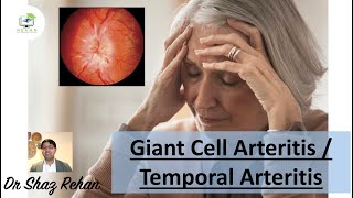 Giant Cell Arteritis GCA  Temporal Arteritis  All You Need to Know I Dr Shaz Rehan 2022 [upl. by Carver540]