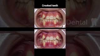 Super crooked Braces treatment 🦷 dentalcare dentist satisfying dentalclinic satisfying shorts [upl. by Darice]