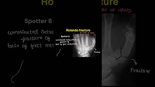 Radiology spotters on our YouTube channel radiologycases spotters neet neetpg pediatrics xray [upl. by Ailimaj976]