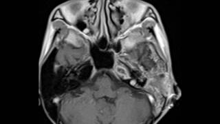 Petrous Apex Abscess [upl. by Fontes]