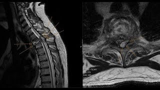 Spinal epidural abscess  spondylodiscitis  insufficiency spinal fracture CT and MRI correlation [upl. by Altheta]