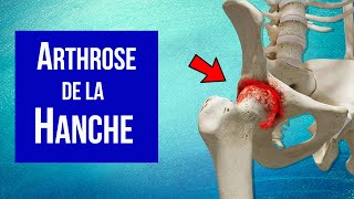 Arthrose de la hanche  Explication et Traitement [upl. by Carry]