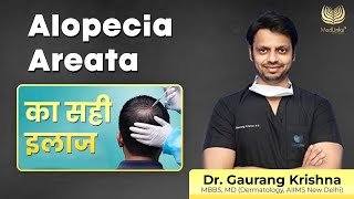 Alopecia Areata का सही इलाज  Best Treatment for Alopecia Areata  Medlinks [upl. by Vasos739]