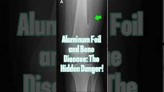 Aluminum Foil and Bone Disease The Hidden Danger [upl. by Cowen]