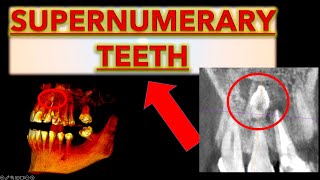 How to Make Sure it is a Supernumerary Tooth Extra teeth in mouth hyperdontia extra front teeth [upl. by Yehsa212]