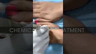 Chemical Peel Treatment at Skinaa Clinic shorts viral [upl. by Anawk]